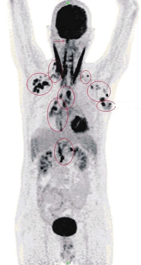 Whole Body Petct Showing Multiple Foci Of Lymphadenopathy In Bilateral