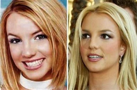 Britney Spears Before And After Plastic Surgery Nose Breasts Facelift