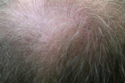 Pourquoi Les Hommes Perdent Leurs Cheveux Chute De Cheveux Homme