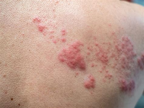 Can Humans Get A Rash From Dogs