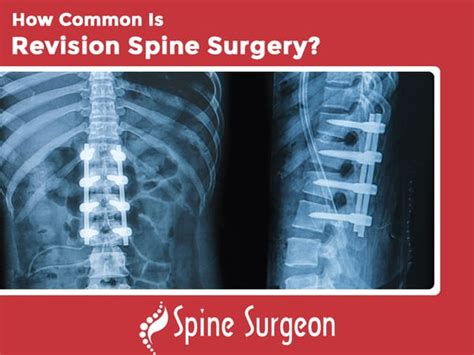 How Common Is Revision Spine Surgery Spine Surgeon