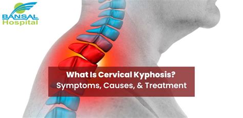 What Is Cervical Kyphosis Symptoms Causes And Treatment