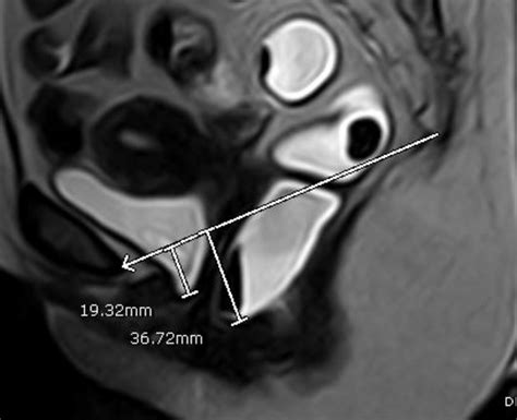 Mid Sagittal T Maximum Straining Image Showing Mild Cystocele And