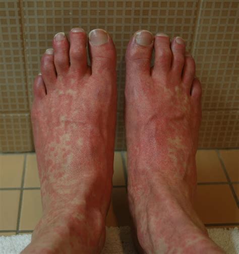 Heat Rash On Top Of Feet Foot Rash Causes Symptoms Home Remedies