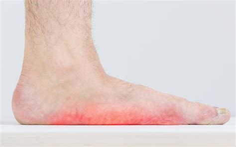 Tips For Identifying And Treating Flatfoot The Orthopaedic Foot And Ankle