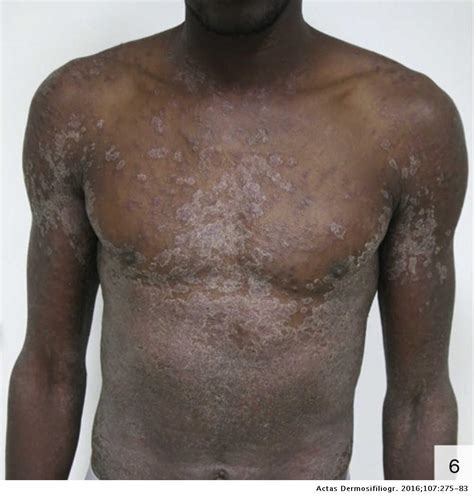 Atypical Cutaneous Manifestations In Syphilis Actas Dermo Sifiliográficas