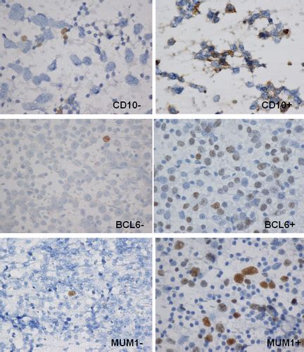 Cd10 Bcl6 And Mum1 Expression In Diffuse Large B‐cell Lymphoma On Fna