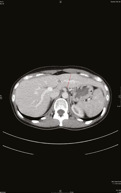 Ct Of The Liver Axial Portal Venous Phase Ct Image With The