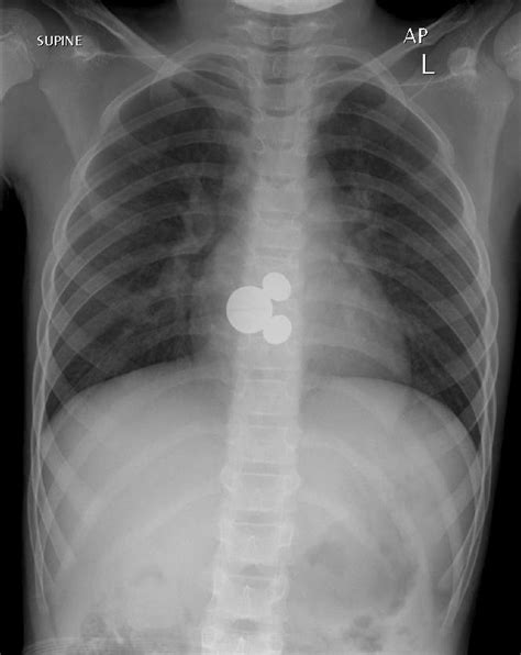Baby Swallowed Coins Buyxraysonline