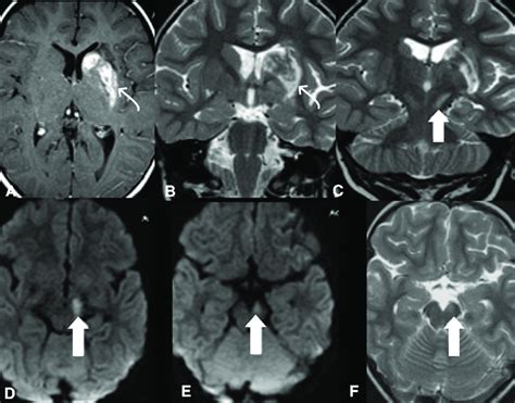 Left Transaxonal Degeneration Of The Nigrostriatal Pathway A And B An