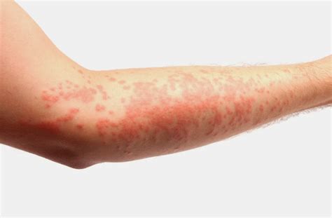 Allergic Contact Dermatitis Treatment Health And Beauty