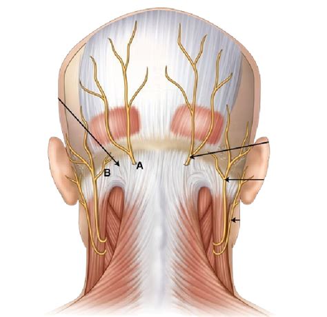 Occipital Nerve Block Nashville Neuroscience Group