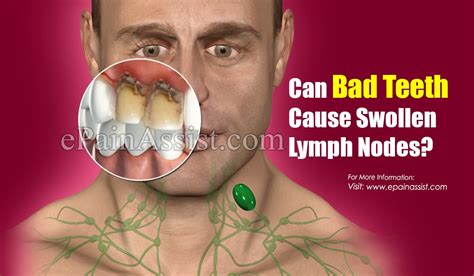 Can Wisdom Teeth Cause Swollen Lymph Nodes Neck Teethwalls