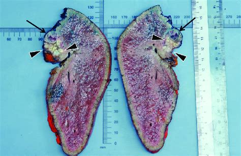 Sections Of Central Hepatectomy Specimen Demonstrating Tumor Arrows
