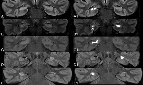 Image Processing To Improve Detection Of Mesial Temporal Sclerosis In