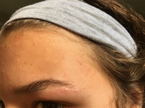 Small And Colorless Spots All Over Forehead Visible Pores And No