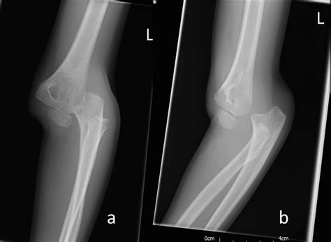 Posterior Elbow Dislocation
