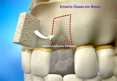 Enxerto ósseo Dentário Como é Feito Como Funciona Implante