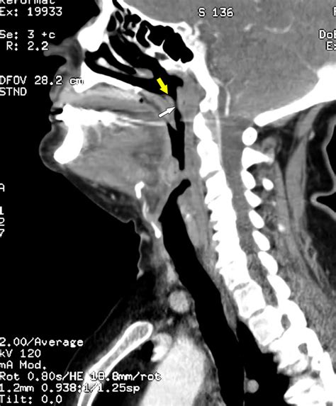 Lingual Tonsil Model