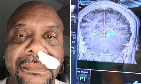 North Carolina Man S Runny Nose That He Had For Five Years Was Actually Fluid Leaking From His