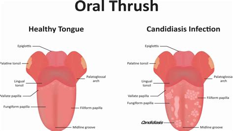 Doctors Reveal The Symptoms And Remedies For Oral Thrush 5 Min Read