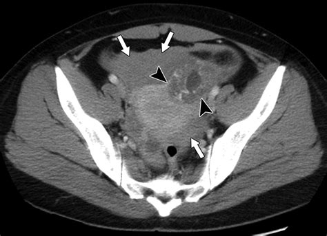 Beyond Ultrasound Ct And Mri Of Ectopic Pregnancy Ajr