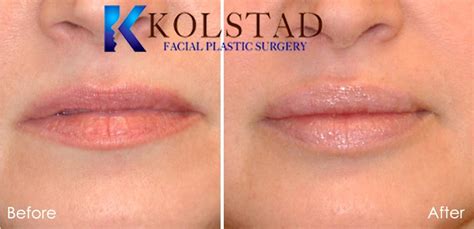 Lip injections cost anywhere from $550 to $2,000—and you'll likely need to top off the lip filler every six to nine months. Best Lip Injections for Fuller Lips Before & After Gallery ...