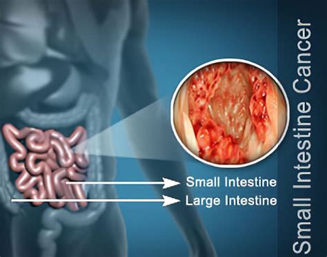 Small Intestine Cancer Risk Factors Small Bowel Adenocarcinoma
