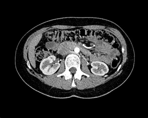 Does Bladder Cancer Show Up On A Ct Scan Updated