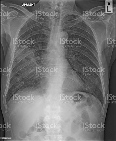 Abscesso Pulmonar Raio X
