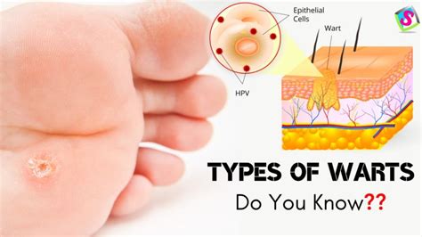 Types Of Warts Do You Know All Types Of Warts What Causes Warts Warts