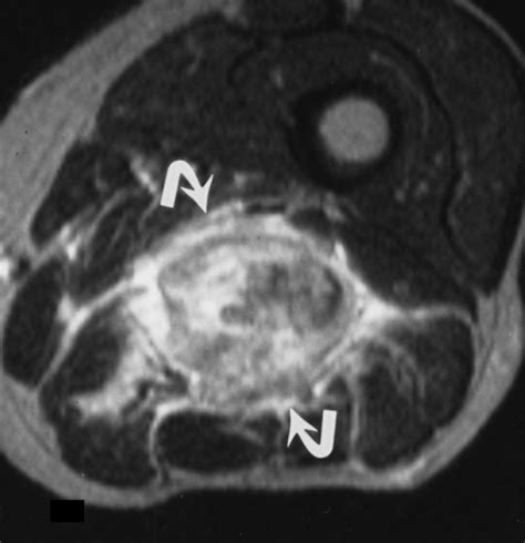 Cross Sectional Imaging Of Peripheral Nerve Sheath Tumors