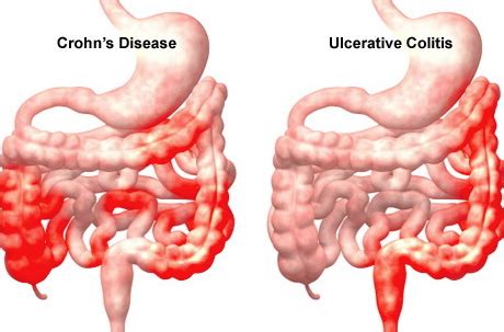 10% of women can also have ovarian cancer. dr. Ulcerative Colitis - IBD - Crohn's Disease Living Probiotics