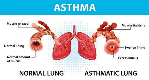Asthma Disability Benefits Cannon Disability Law