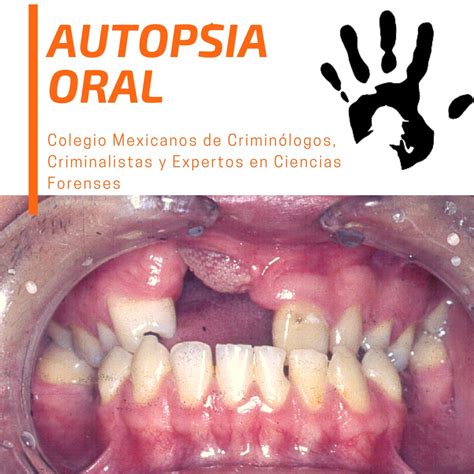 Autopsia Oral La Autopsia O Necropsia Oral Es El Examen Externo E