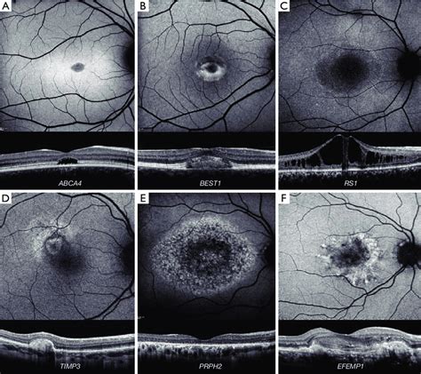 Retinal Imaging Of Macular Dystrophies A F Fundus Autofluorescence