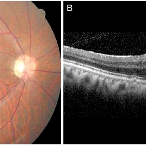 Preoperative Fundus Photograph And Horizontal Spectral Domain Optical