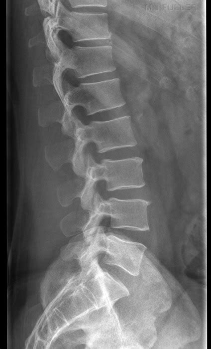Lateral Spine Xray Images Frompo Free Nude Porn Photos Hot Sex Picture