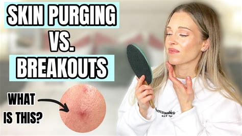Skin Purging Vs Breakouts How To Tell The Difference Youtube