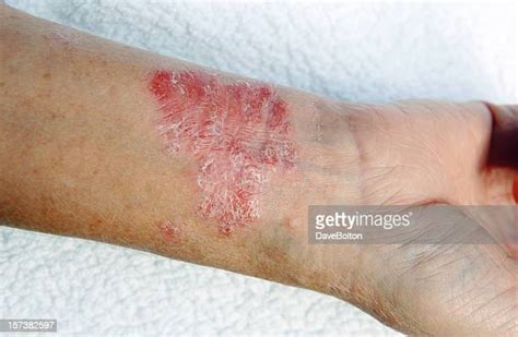 Eczema Arm Photos And Premium High Res Pictures Getty Images
