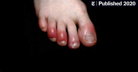 What Is ‘covid Toe Maybe A Strange Sign Of Coronavirus Infection