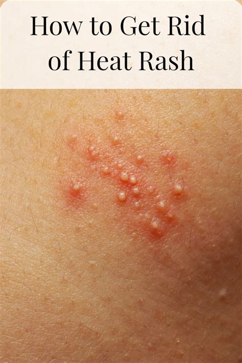 How To Get Rid Of Prickly Heat Heat Rash Heat Rash Prickly Heat Prickly Heat Remedies