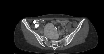 The development of secondary sexual characters is normal as well as that the karyotype (46,xx). Mayer-Rokitansky-Küster-Hauser syndrome (atypical) | Image ...