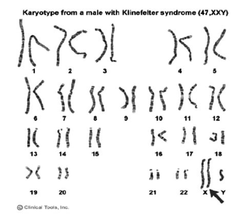 male karyotype with klinefelter syndrome download scientific diagram