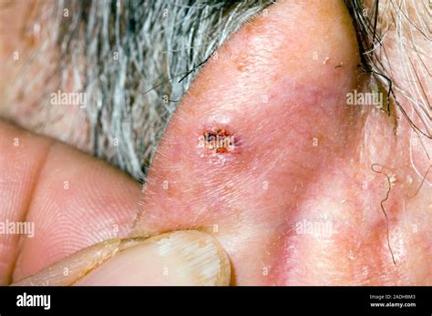 Basal Cell Carcinoma Bcc Or Rodent Ulcer On The Back Of A 79 Year