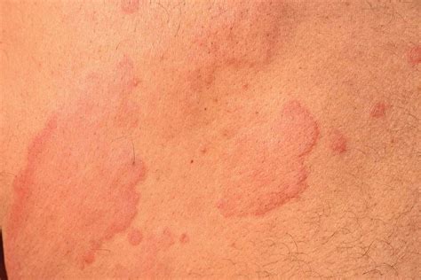 Hives Rash Pictures