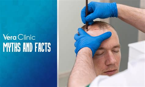 Hair Transplant Facts Myths