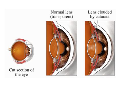 What To Expect Before During And After Cataract Surgery Hubpages