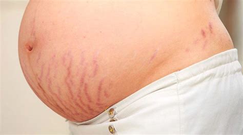 How To Remove Stretch Marks After Pregnancy 11 Amazing Remedy