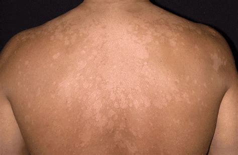 Hypopigmentation Of Skin Causes And Treatments